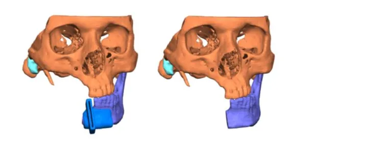 Resection guide design