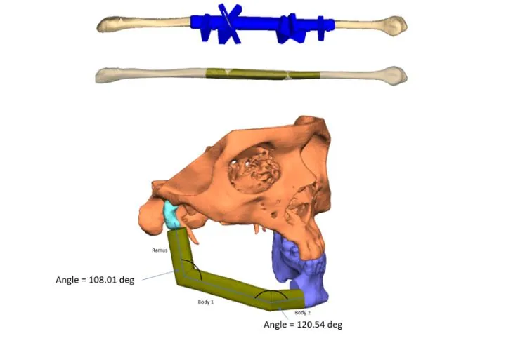 Fibula segments forming the neo-mandible