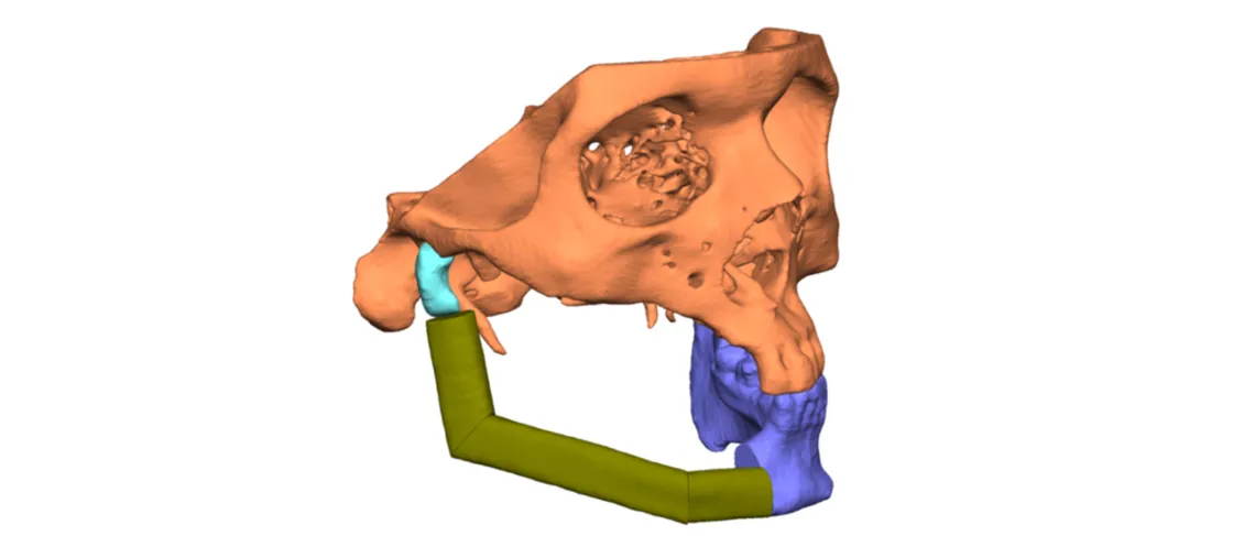 Mandibular reconstruction using fibula graft