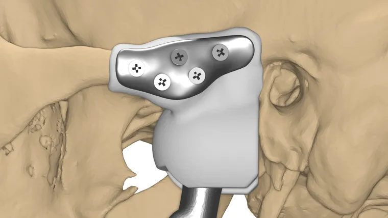 Fossa component design