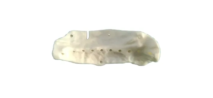 Patient-specific drilling jig for heterotopic ossification