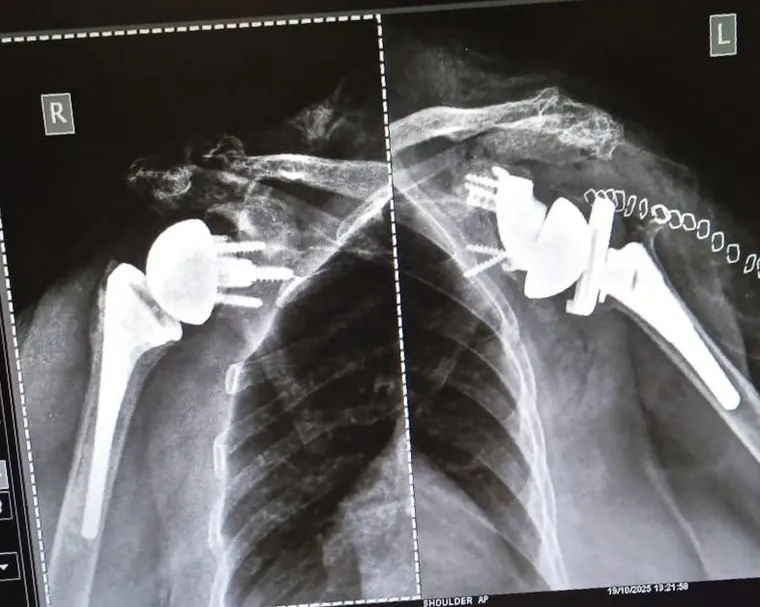 Postoperative imaging