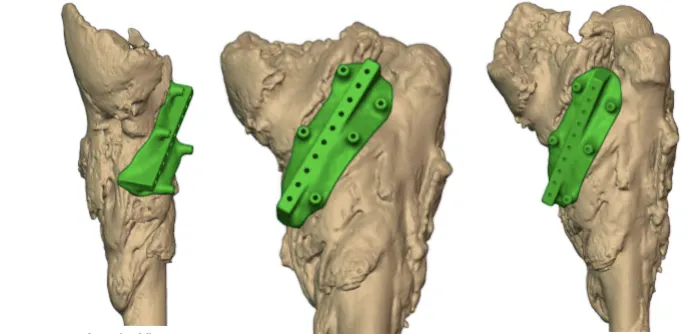 Left-side resection guide