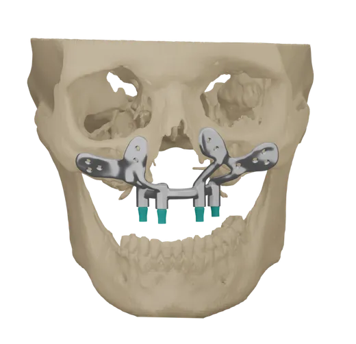 Patient-specific maxilla implant