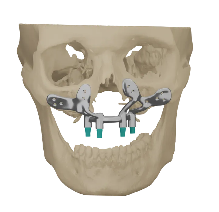 Patient-specific maxilla implant