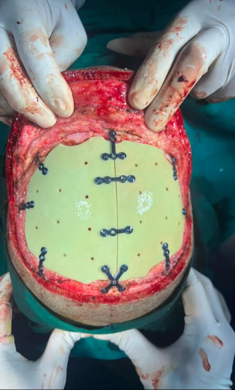 Postoperative result