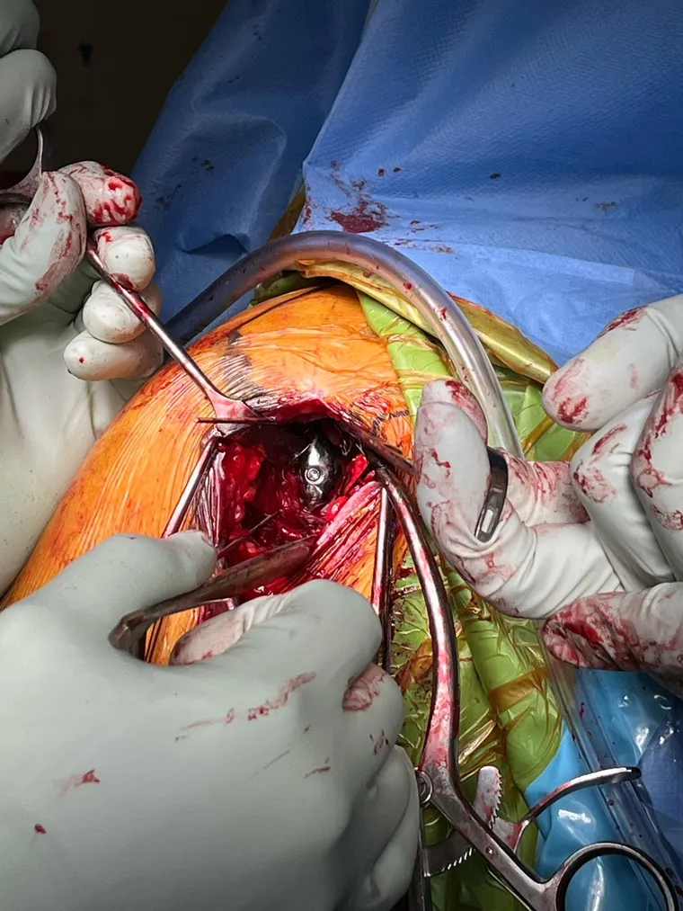 Postoperative imaging