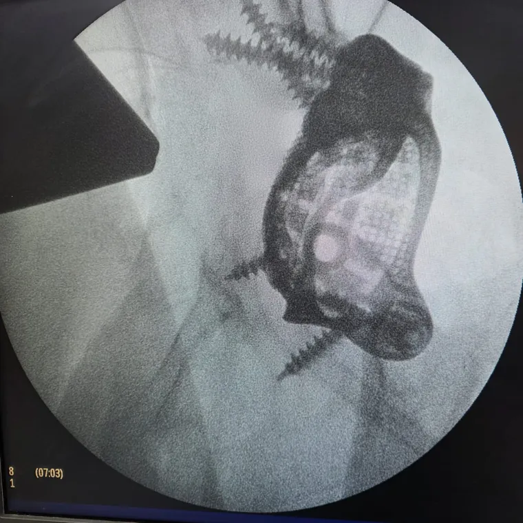 Post-operative outcome