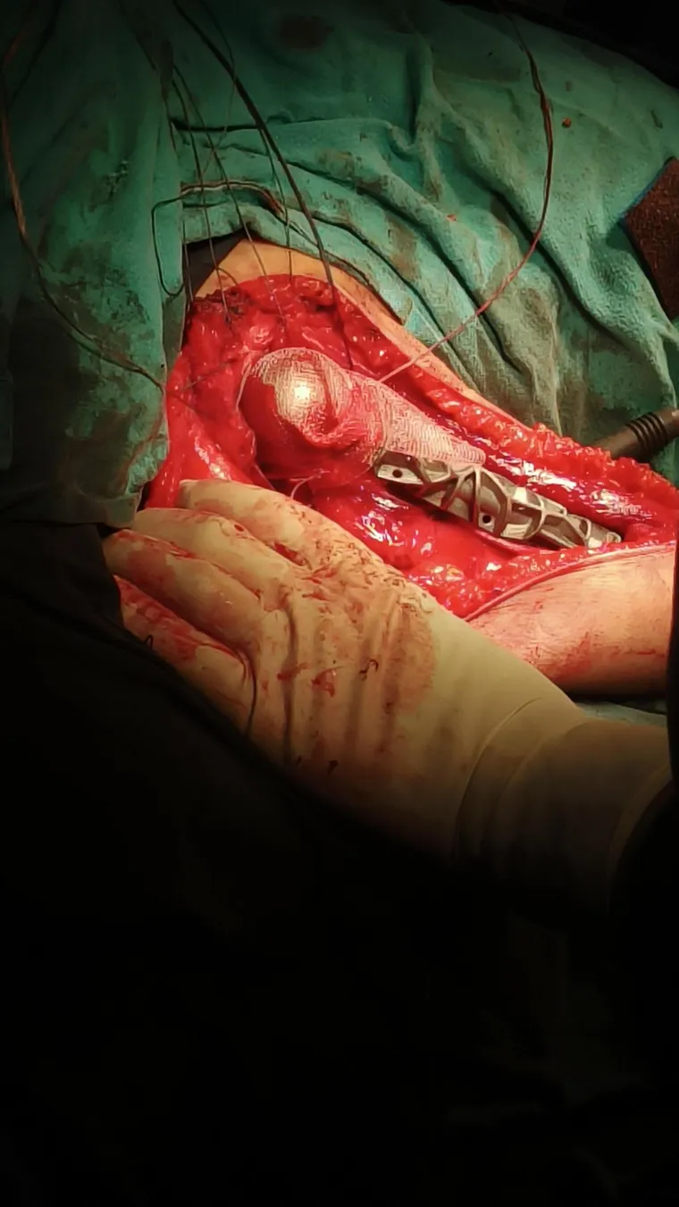 Postoperative outcome