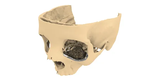Orbital Implant
