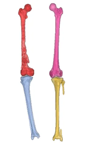 Failed rod implant and distal femur fragments