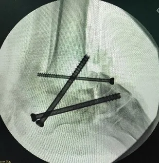 Corrected foot alignment