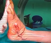 Postoperative result