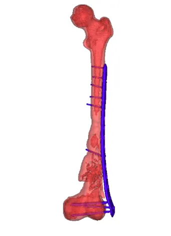 Segmented femur anatomy