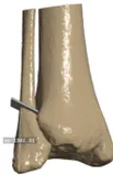 Osteotomy planning