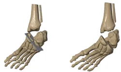Calcaneocuboid and talonavicular osteotomies