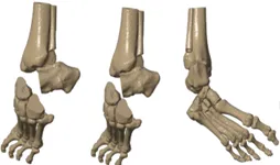 Fusion with fixation screws