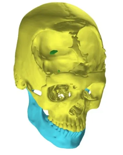 1:1 digital model of the cranial defect