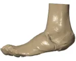 Post-op soft tissue