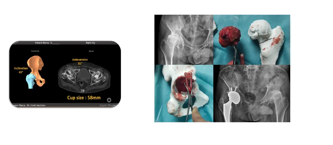 Patient-specific acetabular cup positioning guide