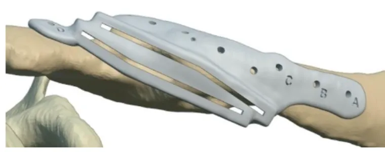 Resection guide design