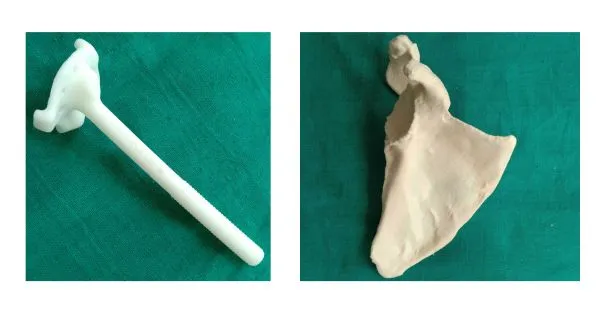 3D-printed glenoid guide and scapula model for reverse shoulder arthroplasty