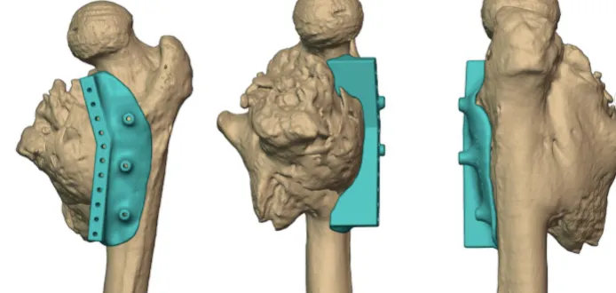 Right-side resection guide