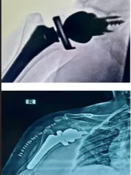 Postoperative result