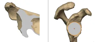 Central screw depth and bone trim plan