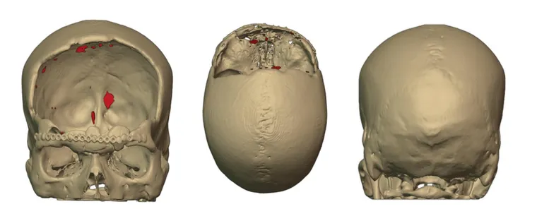 Preoperative imaging