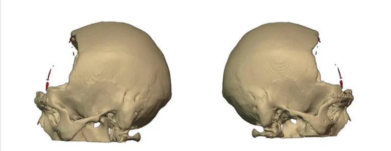 Preoperative skull model