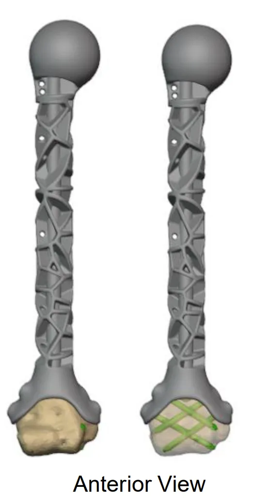 Customised humerus implant planning