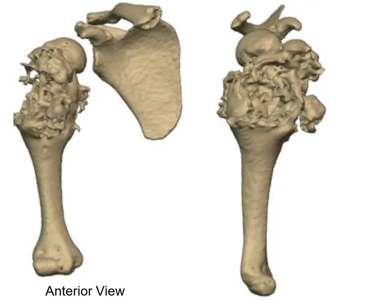 Tumour involvement in the humerus