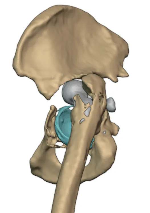Preoperative deformity analysis