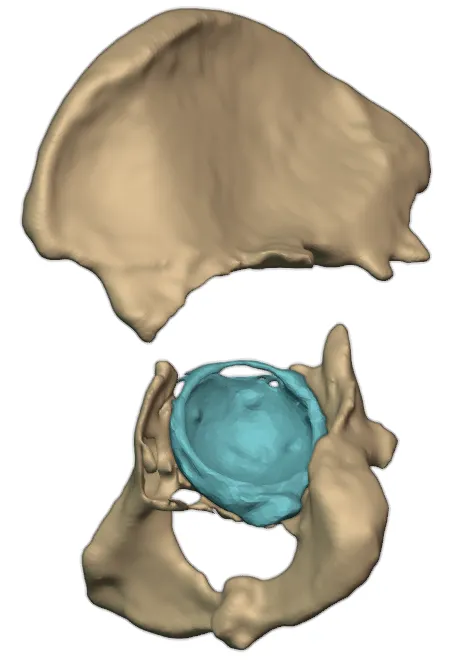 Bilateral pelvic discontinuity