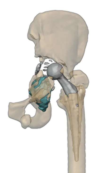 Postoperative CT showing cup dislocation