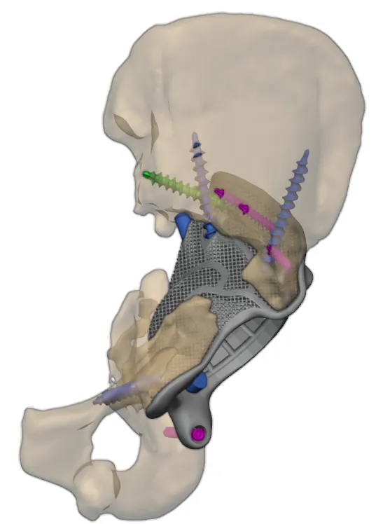 Custom FTL implant designed for the left hip