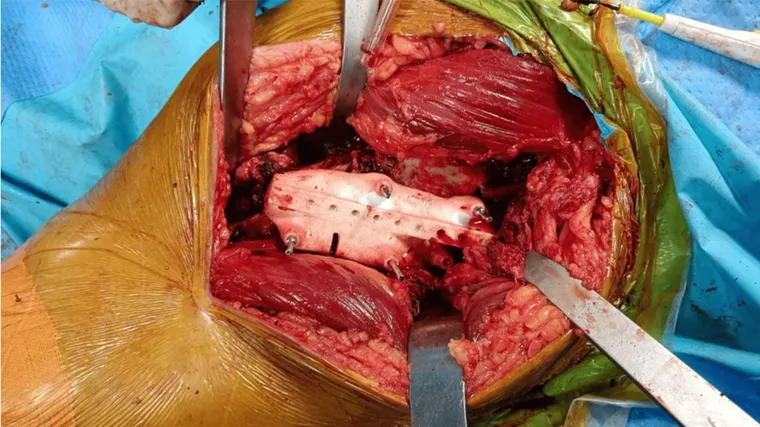 Intraoperative procedure