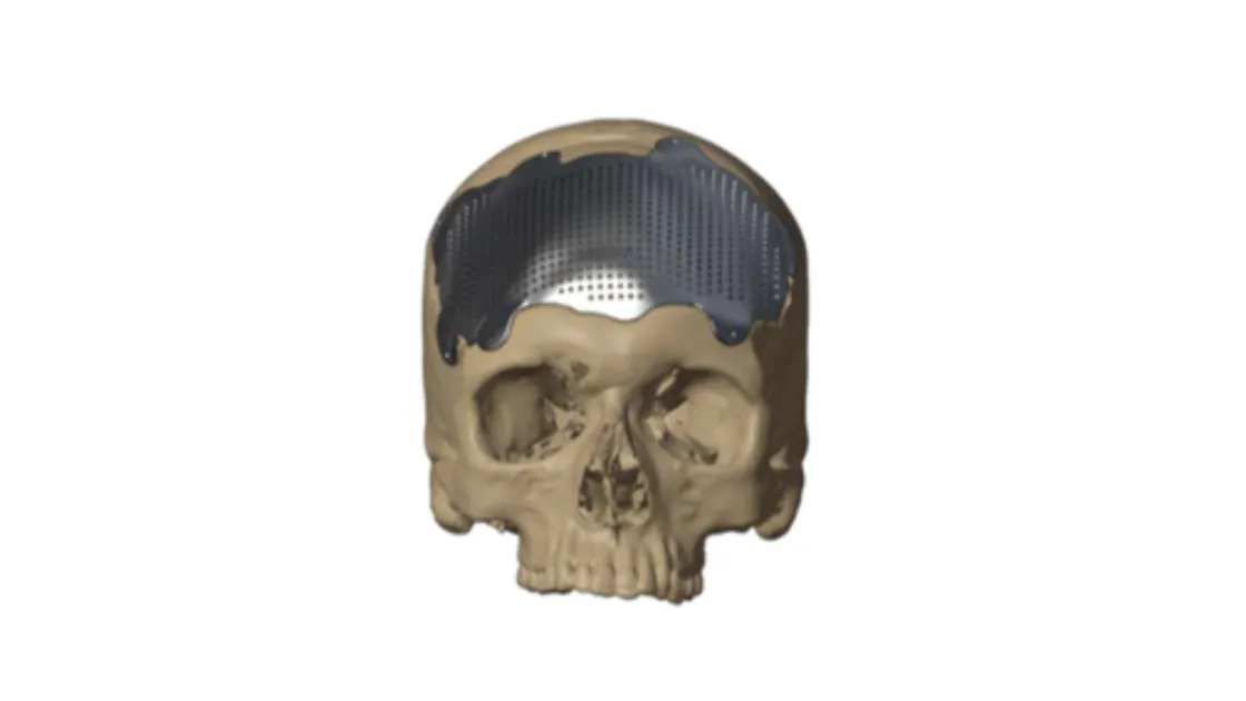 Patient-specific titanium cranial plate