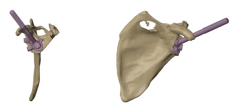 Glenoid axis guide