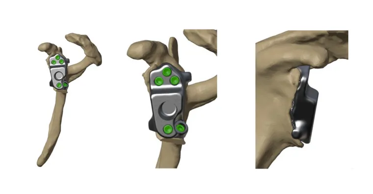 Custom glenoid implant