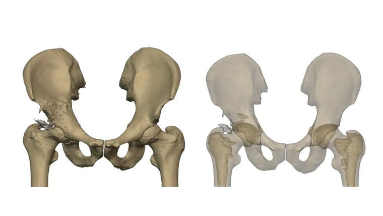 Preoperative imaging of the right hemipelvis