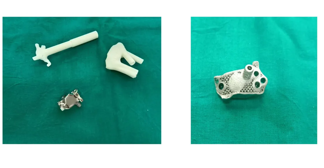 Patient-specific custom glenoid implant for reverse shoulder arthroplasty