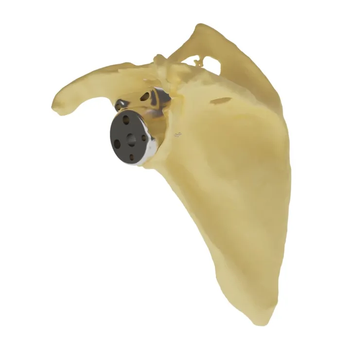 ReGlen customised glenoid augment