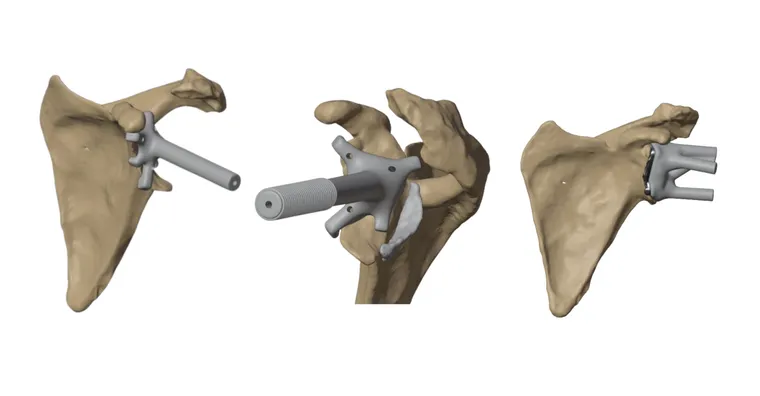 CT-based 3D planning