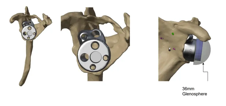 CT-based segmentation and implant planning