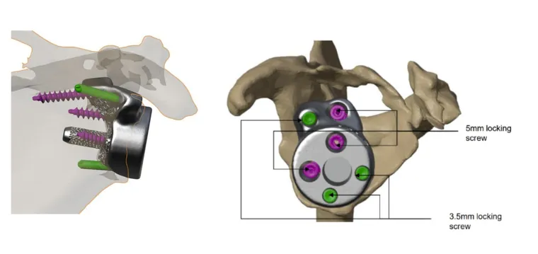 Locking screw configuration