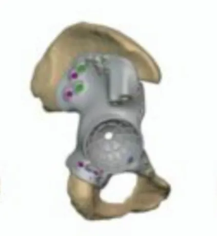 Custom FTL cup for pelvic tumour resection