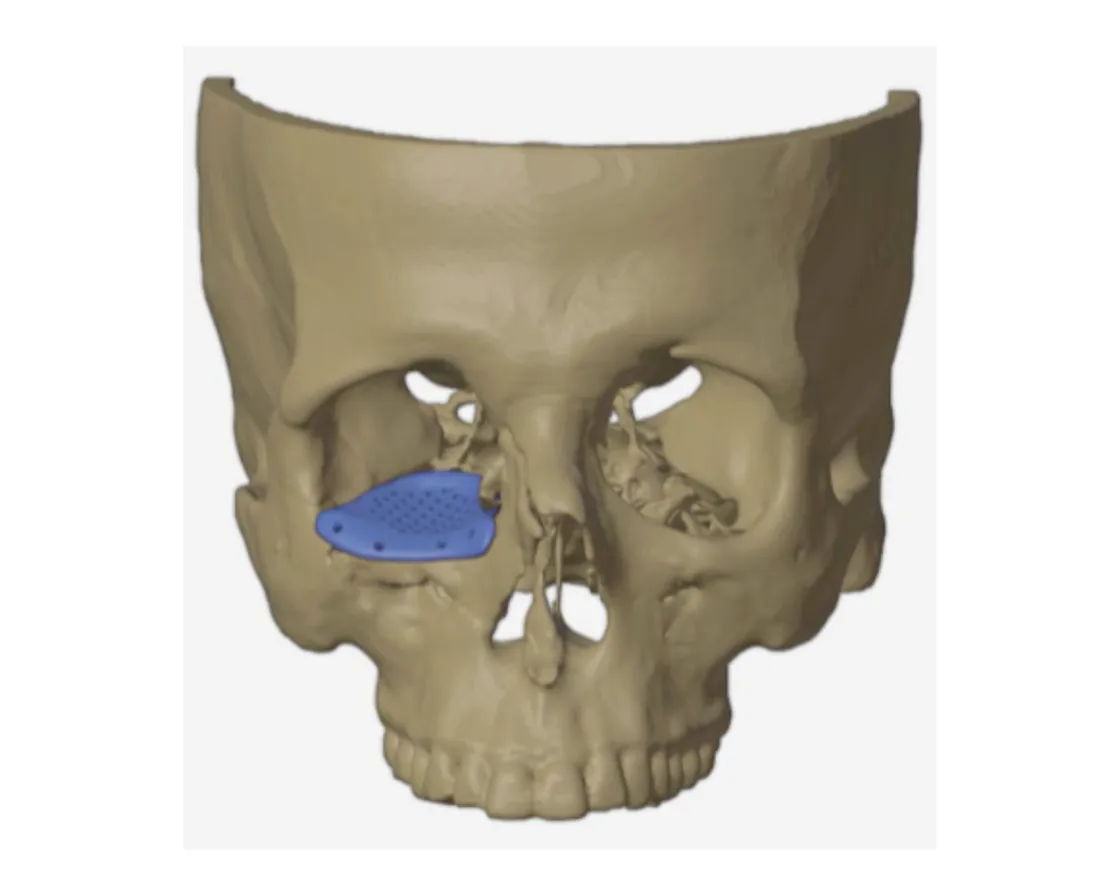 Custom orbital floor implant