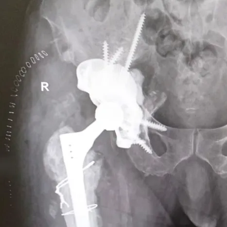 Post-operative radiograph of a custom FTL acetabular cup